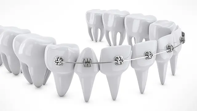 部分矯正とは？の画像